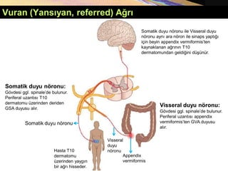 Vuran (Yansıyan, referred) Ağrı
Somatik duyu nöronu:
Gövdesi ggl. spinale’de bulunur.
Periferal uzantısı T10
dermatomu üzerinden deriden
GSA duyusu alır.
Somatik duyu nöronu ile Visseral duyu
nöronu aynı ara nöron ile sinaps yaptığı
için beyin appendix vermiformis’ten
kaynaklanan ağrının T10
dermatomundan geldiğini düşünür.
Visseral duyu nöronu:
Gövdesi ggl. spinale’de bulunur.
Periferal uzantısı appendix
vermiformis’ten GVA duyusu
alır.
Visseral
duyu
nöronu
Appendix
vermiformis
Somatik duyu nöronu
Hasta T10
dermatomu
üzerinden yaygın
bir ağrı hisseder.
 