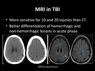 MRI in TBI
• More sensitive for 10 and 20 injuries than CT
• Better differentiation of hemorrhagic and
non-hemorrhagic lesions in acute phase
Diffuse axonal injury
 