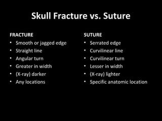 Skull Fracture vs. Suture
FRACTURE
• Smooth or jagged edge
• Straight line
• Angular turn
• Greater in width
• (X-ray) darker
• Any locations
SUTURE
• Serrated edge
• Curvilinear line
• Curvilinear turn
• Lesser in width
• (X-ray) lighter
• Specific anatomic location
 