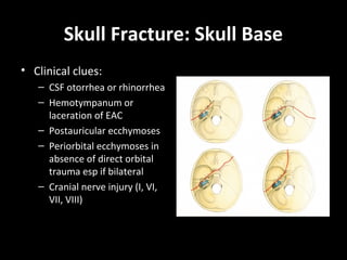 Skull Fracture: Skull Base
• Clinical clues:
– CSF otorrhea or rhinorrhea
– Hemotympanum or
laceration of EAC
– Postauricular ecchymoses
– Periorbital ecchymoses in
absence of direct orbital
trauma esp if bilateral
– Cranial nerve injury (I, VI,
VII, VIII)
 