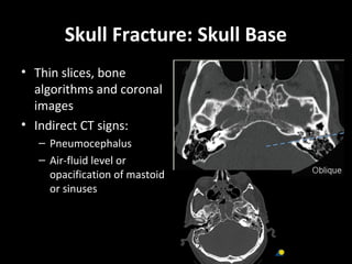 Skull Fracture: Skull Base
• Thin slices, bone
algorithms and coronal
images
• Indirect CT signs:
– Pneumocephalus
– Air-fluid level or
opacification of mastoid
or sinuses
 