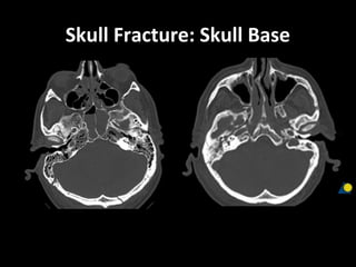 Skull Fracture: Skull Base
 