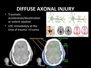 DIFFUSE AXONAL INJURY
• Traumatic
acceleration/deceleration
or violent rotation
• LOC immediately at the
time of trauma -> coma
 