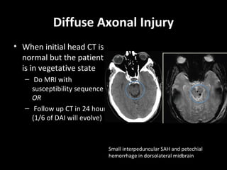 Diffuse Axonal Injury
• When initial head CT is
normal but the patient
is in vegetative state
– Do MRI with
susceptibility sequence
OR
– Follow up CT in 24 hours
(1/6 of DAI will evolve)
Small interpeduncular SAH and petechial
hemorrhage in dorsolateral midbrain
 