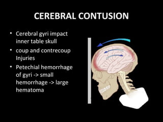 CEREBRAL CONTUSION
• Cerebral gyri impact
inner table skull
• coup and contrecoup
Injuries
• Petechial hemorrhage
of gyri -> small
hemorrhage -> large
hematoma
 