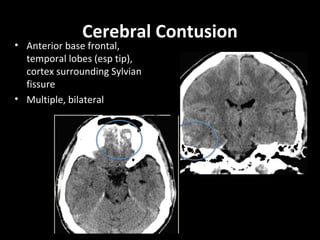 Cerebral Contusion
• Anterior base frontal,
temporal lobes (esp tip),
cortex surrounding Sylvian
fissure
• Multiple, bilateral
 