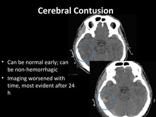 Cerebral Contusion
• Can be normal early; can
be non-hemorrhagic
• Imaging worsened with
time, most evident after 24
h
 
