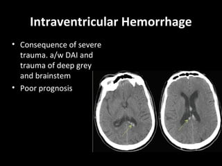 Intraventricular Hemorrhage
• Consequence of severe
trauma. a/w DAI and
trauma of deep grey
and brainstem
• Poor prognosis
 