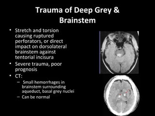 Trauma of Deep Grey &
Brainstem
• Stretch and torsion
causing ruptured
perforators, or direct
impact on dorsolateral
brainstem against
tentorial incisura
• Severe trauma, poor
prognosis
• CT:
– Small hemorrhages in
brainstem surrounding
aqueduct, basal grey nuclei
– Can be normal
 