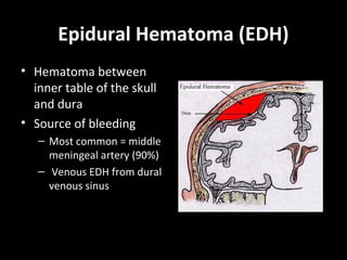 Epidural Hematoma (EDH)
• Hematoma between
inner table of the skull
and dura
• Source of bleeding
– Most common = middle
meningeal artery (90%)
– Venous EDH from dural
venous sinus
 