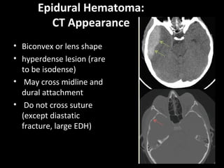 Epidural Hematoma:
CT Appearance
• Biconvex or lens shape
• hyperdense lesion (rare
to be isodense)
• May cross midline and
dural attachment
• Do not cross suture
(except diastatic
fracture, large EDH)
 