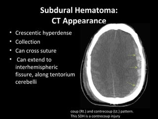 Subdural Hematoma:
CT Appearance
• Crescentic hyperdense
• Collection
• Can cross suture
• Can extend to
interhemispheric
fissure, along tentorium
cerebelli
coup (Rt.) and contrecoup (Lt.) pattern.
This SDH is a contrecoup injury
 