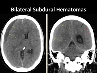 Bilateral Subdural Hematomas
 