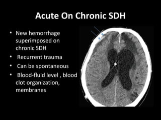 Acute On Chronic SDH
• New hemorrhage
superimposed on
chronic SDH
• Recurrent trauma
• Can be spontaneous
• Blood-fluid level , blood
clot organization,
membranes
 