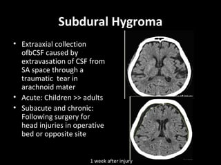 Subdural Hygroma
• Extraaxial collection
ofbCSF caused by
extravasation of CSF from
SA space through a
traumatic tear in
arachnoid mater
• Acute: Children >> adults
• Subacute and chronic:
Following surgery for
head injuries in operative
bed or opposite site
1 week after injury
 
