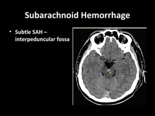 Subarachnoid Hemorrhage
• Subtle SAH –
interpeduncular fossa
 
