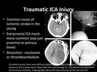 Traumatic ICA Injury
• Common cause of
ischemic stroke in the
young
• Extracranial ICA much
more common (esp just
proximal to petrous
bone)
• Dissection ->occlusion
or thromboembolism
At initial trauma, there were diffuse subarachnoid hemorrhage, pneumocephalus, facial
fractures and C-spine injury. Days after the injury (image C) , the patient developed left
ICA territory infarction. Angiiography (D) confirmed occlusion of the cervical ICA.
 