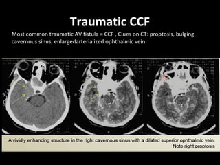 Traumatic CCF
Most common traumatic AV fistula = CCF , Clues on CT: proptosis, bulging
cavernous sinus, enlargedarterialized ophthalmic vein
 