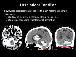 Herniation: Tonsillar
•Downward displacement of tonsils through foramen magnum
Seen with
– Up to ½ of all descending transtentorial herniation
– Up to 2/3 of ascending transtentorial herniation
 