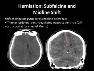 Herniation: Subfalcine and
Midline Shift
Shift of cingulate gyrus across midline below falx
• Thinner ipsilateral ventricle, dilated opposite ventricle (CSF
obstruction at foramen of Monro)
 