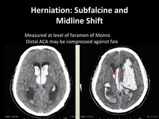 Herniation: Subfalcine and
Midline Shift
Measured at level of foramen of Monro
Distal ACA may be compressed against falx
 