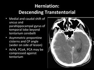 Herniation:
Descending Transtentorial
• Medial and caudal shift of
uncus and
parahippocampal gyrus of
temporal lobe beyond
tentorium cerebelli
• Asymmetric prepontine
cisterns and CP angle
(wider on side of lesion)
• AchA, PCoA, PCA may be
compressed against
tentorium
 