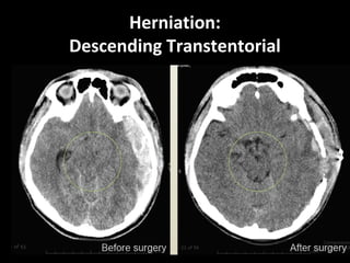 Herniation:
Descending Transtentorial
 