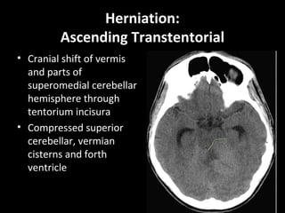 Herniation:
Ascending Transtentorial
• Cranial shift of vermis
and parts of
superomedial cerebellar
hemisphere through
tentorium incisura
• Compressed superior
cerebellar, vermian
cisterns and forth
ventricle
 