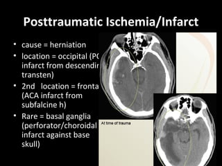 Posttraumatic Ischemia/Infarct
• cause = herniation
• location = occipital (PCA
infarct from descending
transten)
• 2nd location = frontal
(ACA infarct from
subfalcine h)
• Rare = basal ganglia
(perforator/choroidal
infarct against base
skull)
 