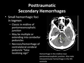 Posttraumatic
Secondary Hemorrhages
• Small hemorrhagic foci
in tegmen
– Classic in midline of
pontomesencephalic
junction
– May be multiple or
extending into cerebellar
peduncles
– Necrosis/hemorrhage of
contralateral cerebral
peduncle “false
localizing sign” Hemorrhage in the midline near
pontomesencephalic junction. Also note
intraventricular hemorrhage in the 4th
ventricle
 