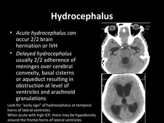 Hydrocephalus
• Acute hydrocephalus can
occur 2/2 brain
herniation or IVH
• Delayed hydrocephalus
usually 2/2 adherence of
meninges over cerebral
convexity, basal cisterns
or aqueduct resulting in
obstruction at level of
ventricles and arachnoid
granulations
Look for “early sign” of hydrocephalus at temporal
horns of lateral ventricles.
When acute with high ICP, there may be hypodensity
around the frontal horns of lateral ventricles
 
