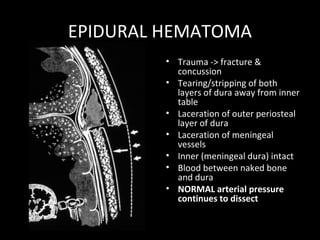 EPIDURAL HEMATOMA
• Trauma -> fracture &
concussion
• Tearing/stripping of both
layers of dura away from inner
table
• Laceration of outer periosteal
layer of dura
• Laceration of meningeal
vessels
• Inner (meningeal dura) intact
• Blood between naked bone
and dura
• NORMAL arterial pressure
continues to dissect
 