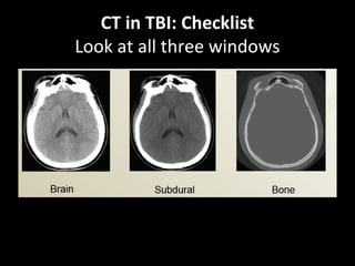 CT in TBI: Checklist
Look at all three windows
 
