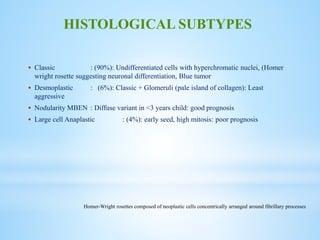  Classic : (90%): Undifferentiated cells with hyperchromatic nuclei, (Homer
wright rosette suggesting neuronal differentiation, Blue tumor
 Desmoplastic : (6%): Classic + Glomeruli (pale island of collagen): Least
aggressive
 Nodularity MBEN : Diffuse variant in <3 years child: good prognosis
 Large cell Anaplastic : (4%): early seed, high mitosis: poor prognosis
HISTOLOGICAL SUBTYPES
Homer-Wright rosettes composed of neoplastic cells concentrically arranged around fibrillary processes
 