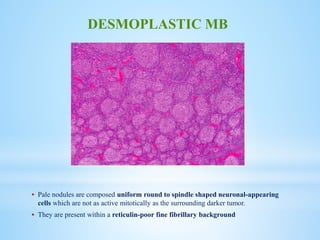  Pale nodules are composed uniform round to spindle shaped neuronal-appearing
cells which are not as active mitotically as the surrounding darker tumor.
 They are present within a reticulin-poor fine fibrillary background
DESMOPLASTIC MB
 