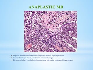  Large cell anaplastic medulloblastoma composed of sheets of highly atypical cells.
 A focus of necrosis is present just above the center of the image.
 The tumor cells have irregular hyperchromatic nuclei with nuclear molding and little cytoplasm
ANAPLASTIC MB
 