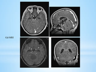 Gd-MRI
 