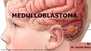MEDULLOBLASTOMA
By
Dr. Ayush Garg
“© Mayo Foundation for Medical Education and Research. All Rights Reserved. Used with permission.”
 