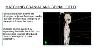 Medulloblatoma - Field Matching In RT Planning - CSI | PPTX
