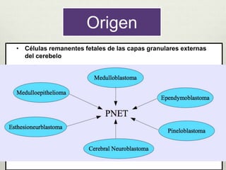 Origen
• Células remanentes fetales de las capas granulares externas
del cerebelo
 