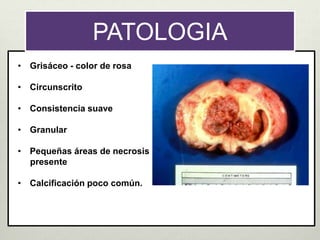 PATOLOGIA
• Grisáceo - color de rosa
• Circunscrito
• Consistencia suave
• Granular
• Pequeñas áreas de necrosis
presente
• Calcificación poco común.
 