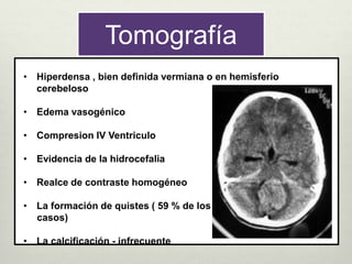 Tomografía
• Hiperdensa , bien definida vermiana o en hemisferio
cerebeloso
• Edema vasogénico
• Compresion IV Ventriculo
• Evidencia de la hidrocefalia
• Realce de contraste homogéneo
• La formación de quistes ( 59 % de los
casos)
• La calcificación - infrecuente
 