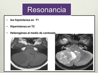 Resonancia
• Iso hipointensa en T1
• Hiperintensa en T2
• Heterogénea al medio de contraste
 