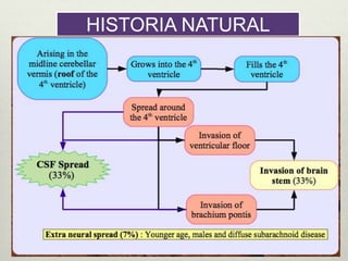 HISTORIA NATURAL
Con origen en el vermis cerebeloso
línea media
( techo del cuarto ventrículo)
Crecimiento en el
cuarto ventrículo
 