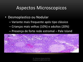 Aspectos Microscopicos
• Desmoplastico ou Nodular
– Variante mais frequente após tipo clássico
– Crianças mais velhas (10%) e adultos (20%)
– Presença de forte rede estromal – Pale Island
Dr. Peterson Xavier da Silva
medpeterson@hotmail.com
 