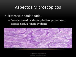 Aspectos Microscopicos
• Extensiva Nodularidade
– Correlacionado a desmoplastico, porem com
padrão nodular mais evidente
Dr. Peterson Xavier da Silva
Dr. Peterson Xavier da Silva
medpeterson@hotmail.com
 