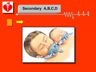 Mega Code. Emergency Mega Code | PDF