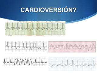 CARDIOVERSIÓN?
 