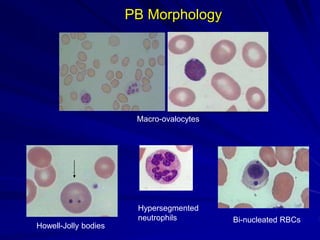 PB Morphology
Macro-ovalocytes
Howell-Jolly bodies
Hypersegmented
neutrophils Bi-nucleated RBCs
 