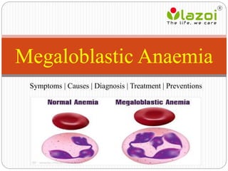 Symptoms | Causes | Diagnosis | Treatment | Preventions
Megaloblastic Anaemia
 